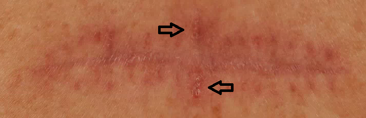 foto 5 basaalcelcarcinoom zelfonderzoek huid